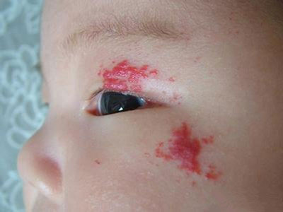 儿童眼周毛细血管破裂图片