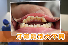 牙箍類別大不同