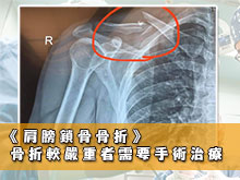 骨折fracture 疾病病徵 Seedoctor 睇醫生網