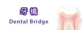 牙橋Dental Bridge