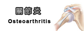 關節炎Osteoarthritis