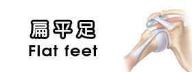 扁平足Flat feet